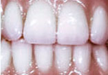 Bleaching-Ergebnis.jpg