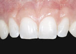Fertig eingestztes Implantat