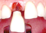 Implantat