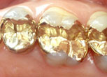 Gold-Inlay