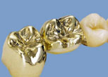 Gold Zahnkrone